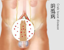 阴虱病